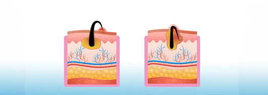 INGEGROEIDE HAARCYSTEN: BEHANDELINGEN, OORZAKEN EN SYMPTOMEN